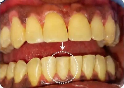 After treatment: the same lower front tooth brought back into line