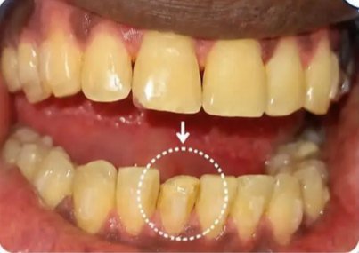 Before treatment: a lower front tooth rotated out of the arch