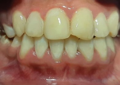 After treatment: an even, uniform shade across both arches
