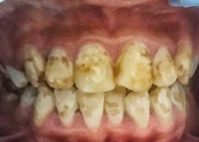 Before treatment: heavy staining and surface damage across upper and lower teeth