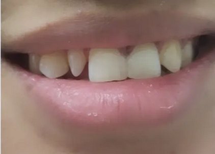 After treatment: an even, balanced upper smile line
