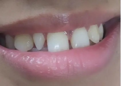 Before treatment: uneven upper front teeth with a stepped smile line
