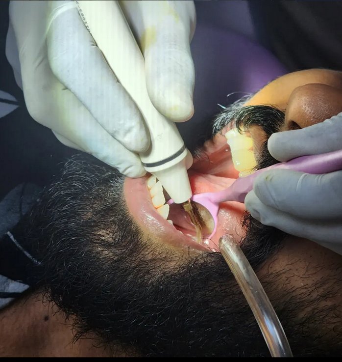 Dentist carrying out a treatment at Dr. Vidhu's 32